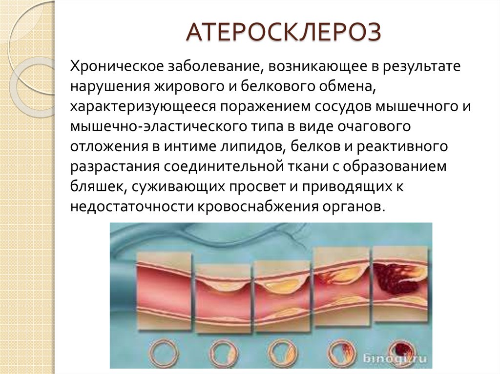 Атеросклероз патанатомия презентация