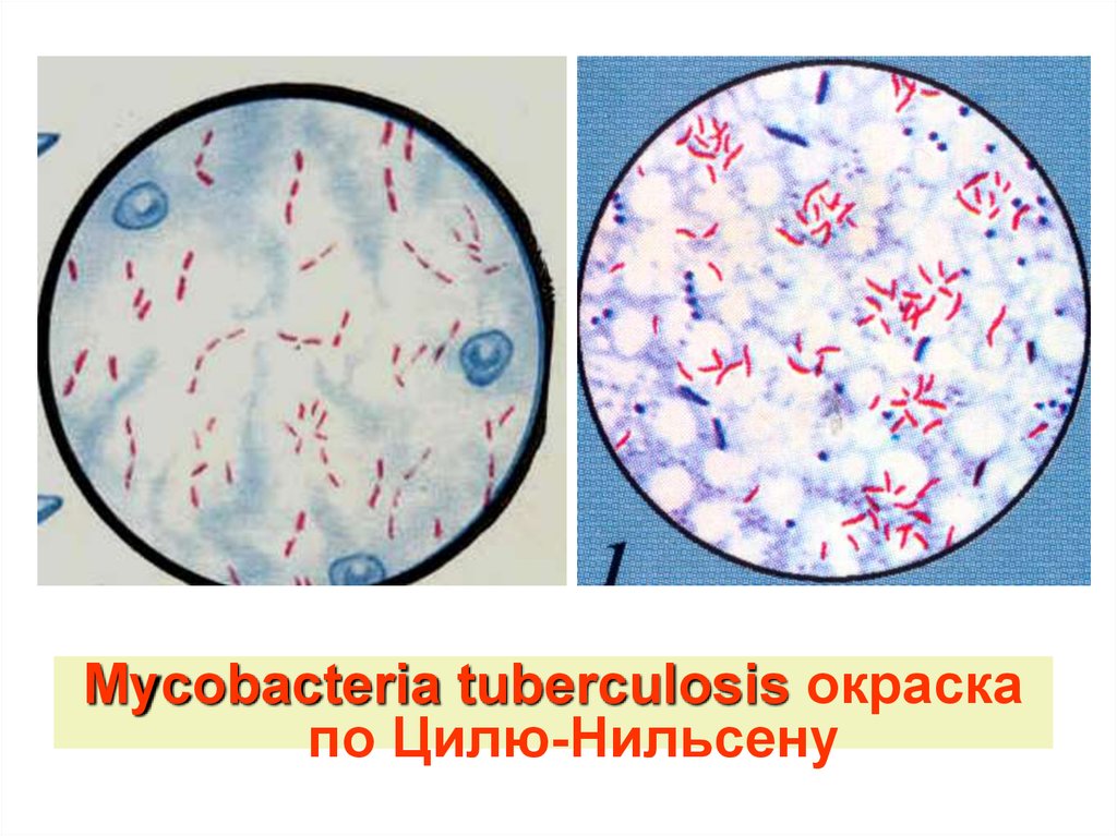 Палочки в мокроте. Микобактерия туберкулеза по Цилю Нильсену. Микобактерии туберкулеза в мокроте окраска по Цилю Нильсену. M tuberculosis окраска по Цилю Нильсену. Туберкулез окраска по Цилю-Нильсену.