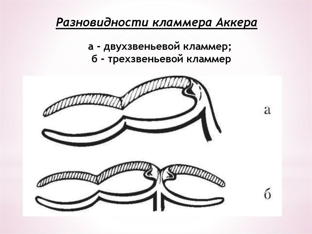 Система нея. Трехзвеньевой кламмер. Двухзвеньевой кламмер. Кламмер Аккера строение. Трехзвеньевой кламмер Аккера.