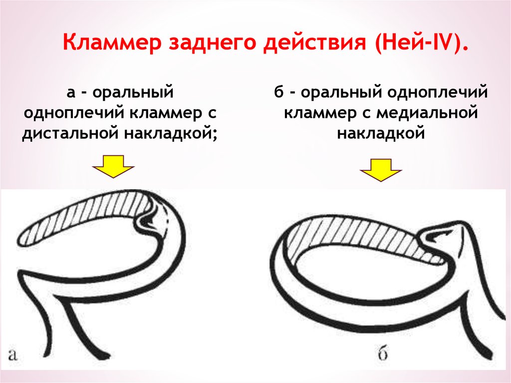 Ея система. Кламмер нея 4 типа. Одноплечий кольцевой кламмер. Одноплечий кламмер заднего(обратного )действия. Кламмер Джексона.