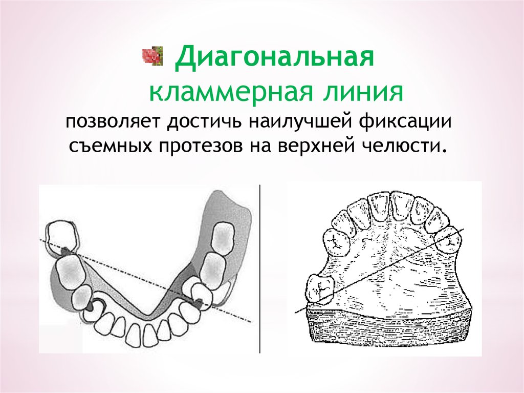 Система нея. Кламмерная линия на верхней челюсти. Кламерная линияина верхней челюсти. Кламмерные линии на нижней челюсти. Оптимальное расположение кламмерной линии на верхней челюсти.