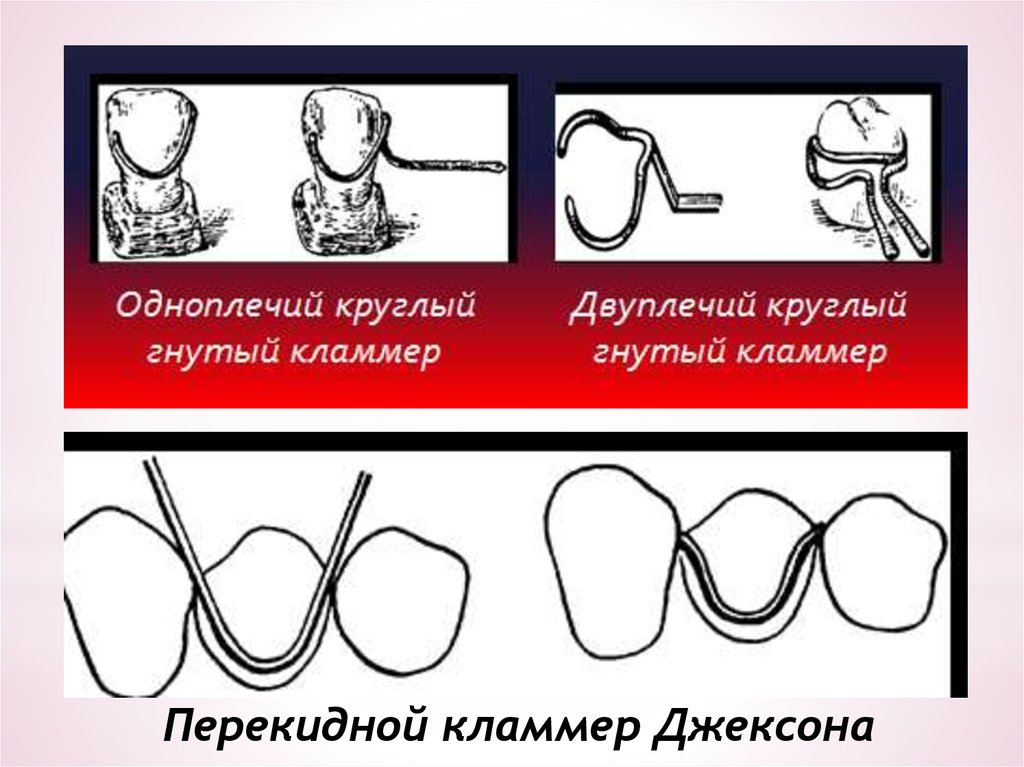 Кламмер адамса. Кламмер Джексона бюгель. Гнутый проволочный одноплечий кламмер. Перекидной одноплечий кламмер. Кламмер Джексона и Адамса.