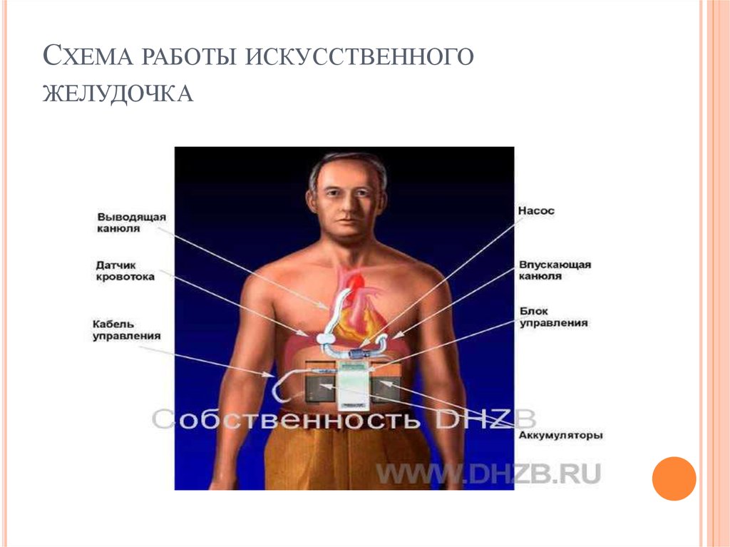 Сколько весит искусственный левый желудочек. Искусственный желудочек сердца. Искусственный левый желудочек. Искусственный левый желудочек устройство. Имплантация искусственного левого желудочка сердца.