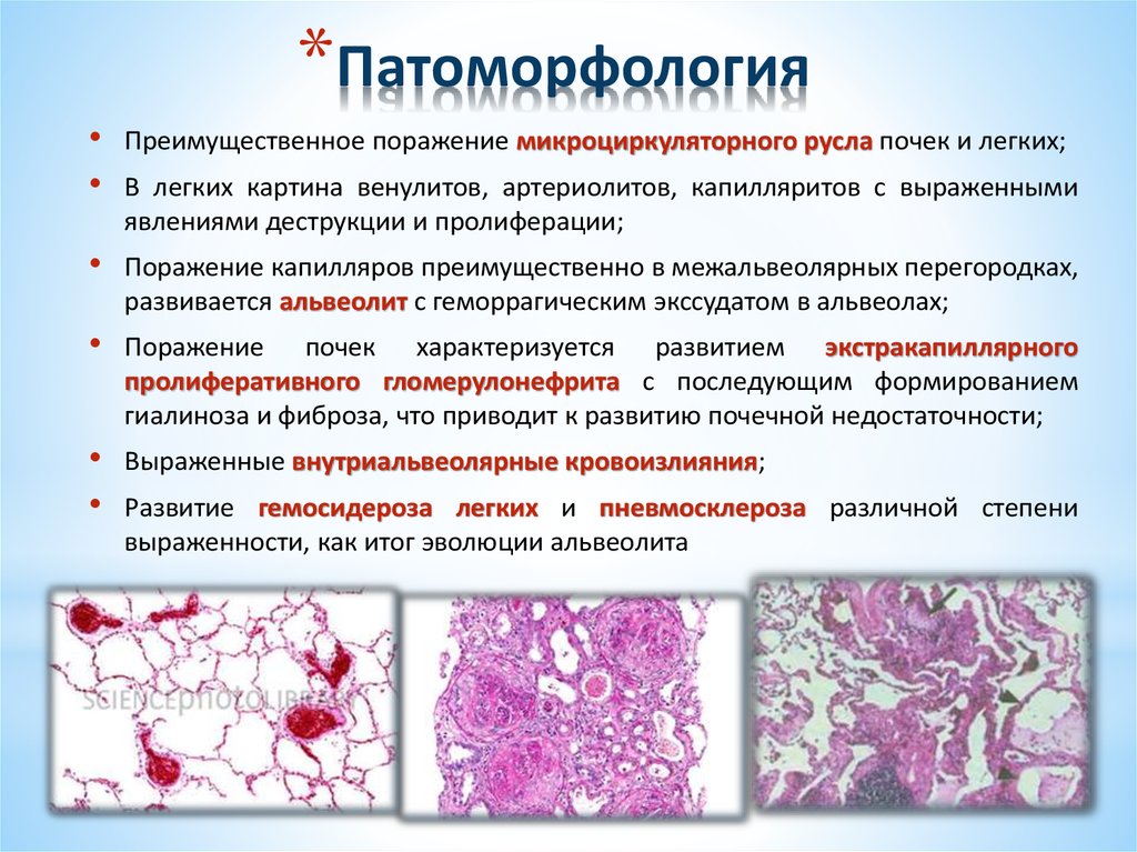 Полиомиелит патологическая анатомия презентация