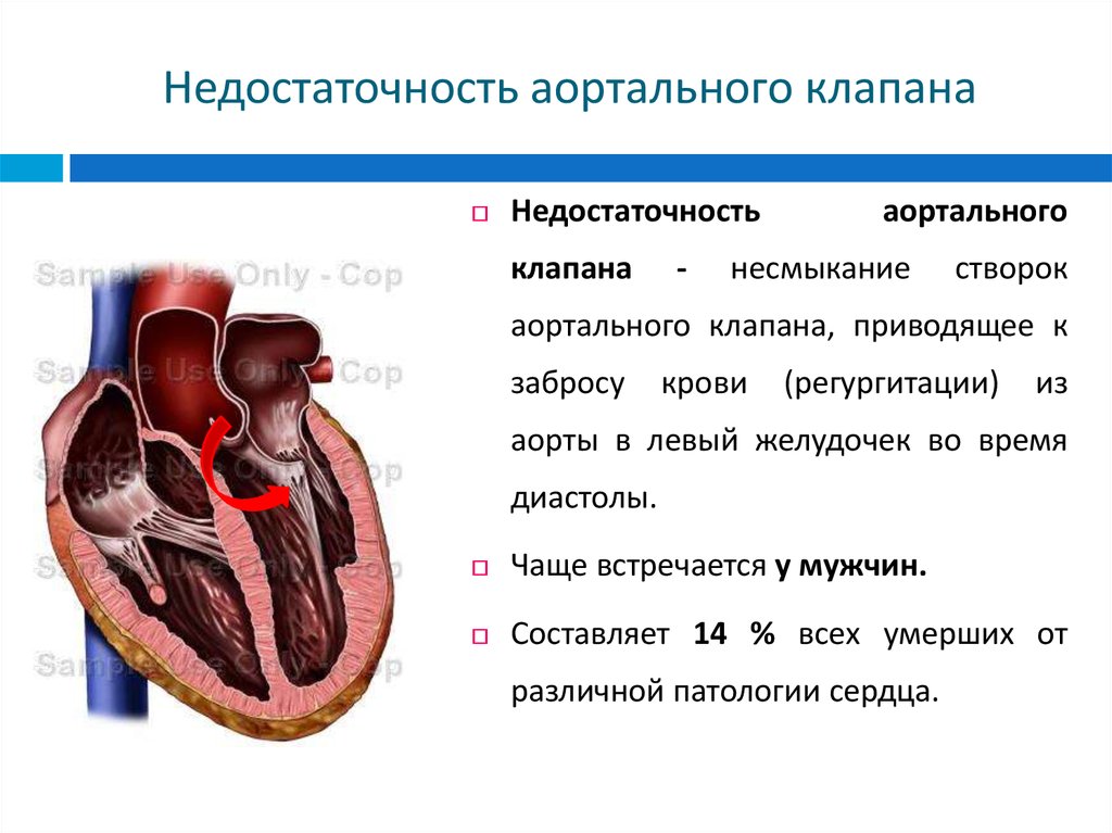 Сердечная недостаточность митрального клапана. Регургитация аортального клапана степени. Недостаточность створок аортального клапана 1 степени. Врожденная недостаточность аортального клапана 1 степени. Уплотненные створки аортального клапана.