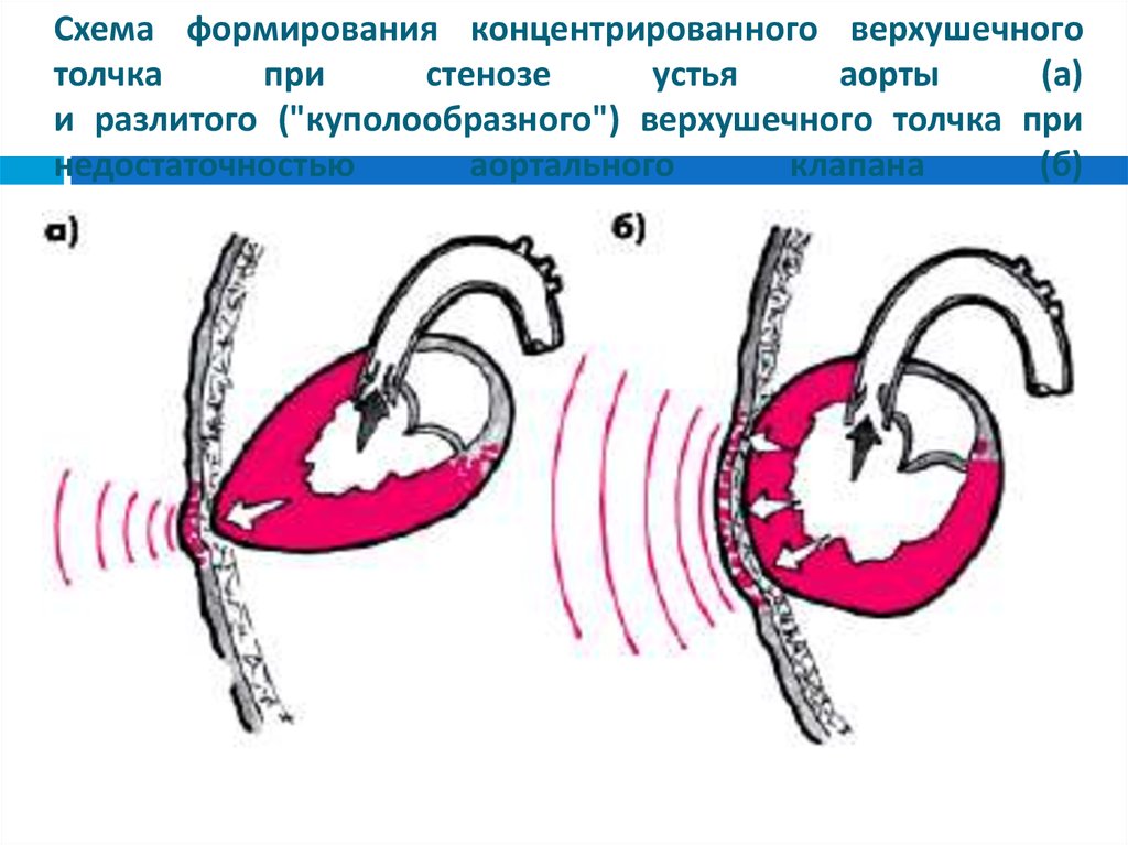 Стеноз устья аорты это