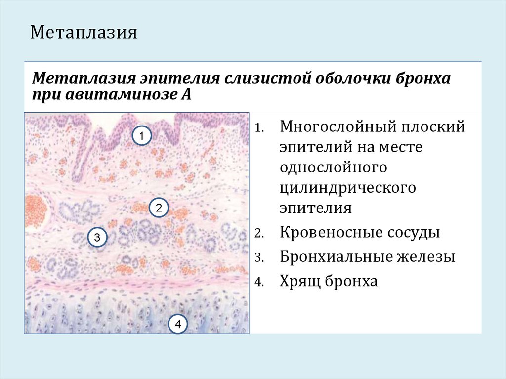 Клетки метаплазированного эпителия с реактивными изменениями. Эпителий бронхов микропрепарат. Дисплазия эпителия гистология. Дисплазия плоского эпителия гистология. Метаплазия эпителия слизистой оболочки бронха.