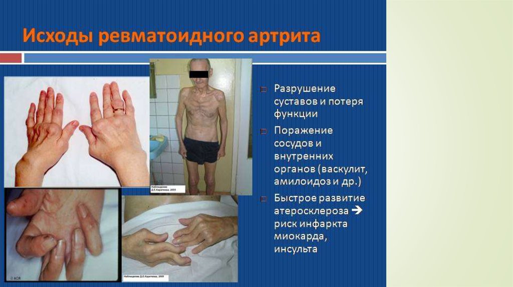 Ревматоидный артрит - презентация онлайн