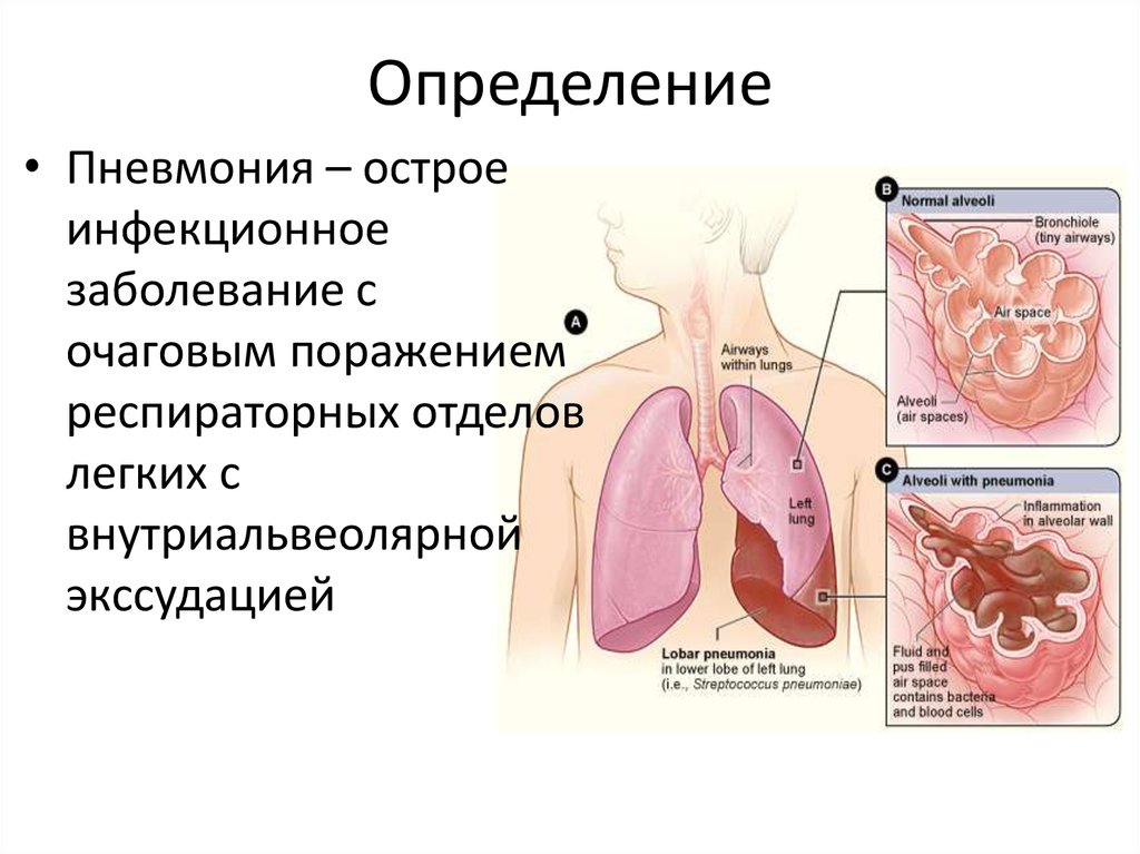 Презентация воспаление легких