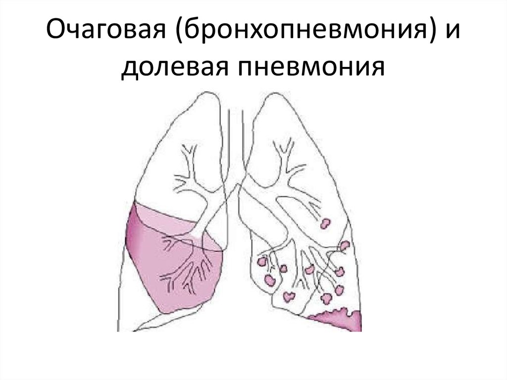 Крупозная пневмония рисунок