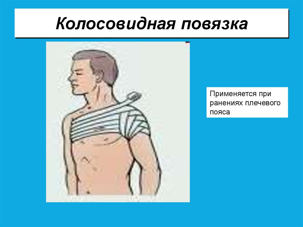 Колосовидная повязка. Повязка при ранении плечевого сустава. Колосовидная повязка применяется для перевязки. При ранении в области плечевого сустава накладывают повязку. Колосовидная повязка на плечо.