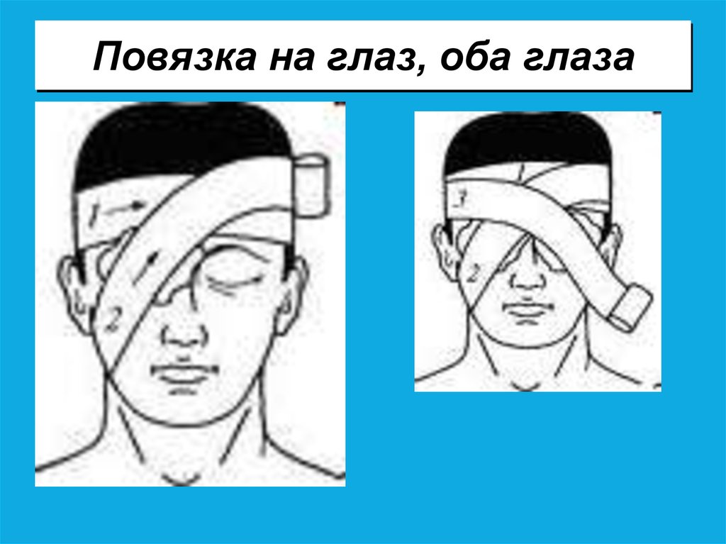 При ранениях глаз или век. Повязка на оба глаза. Накладывание повязки на глаз. Наложение повязки при ранении глаза. Наложение асептической повязки на глаз.