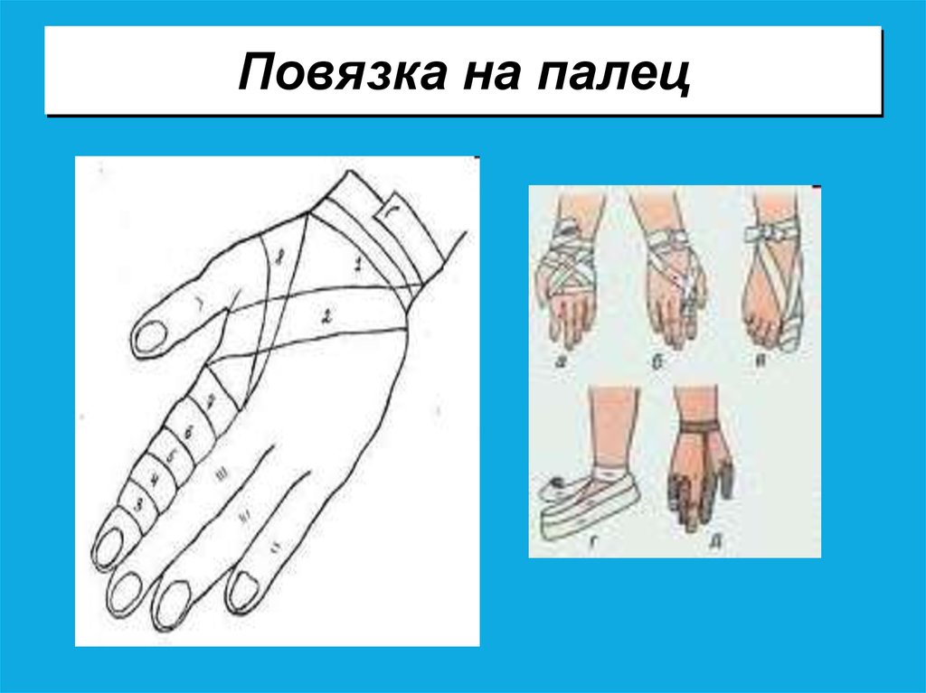Как перевязать палец на руке