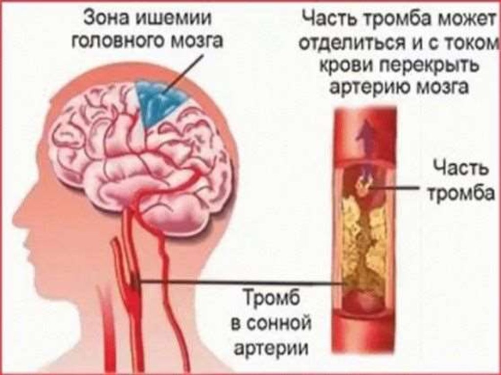 Ишемия головы. Ишемический инсульт поражения артерий. Лекарства при ишемии сосудов головного мозга. Хроническая ишемия головного мозга синдромы. Атеросклероз сосудов головного мозга.