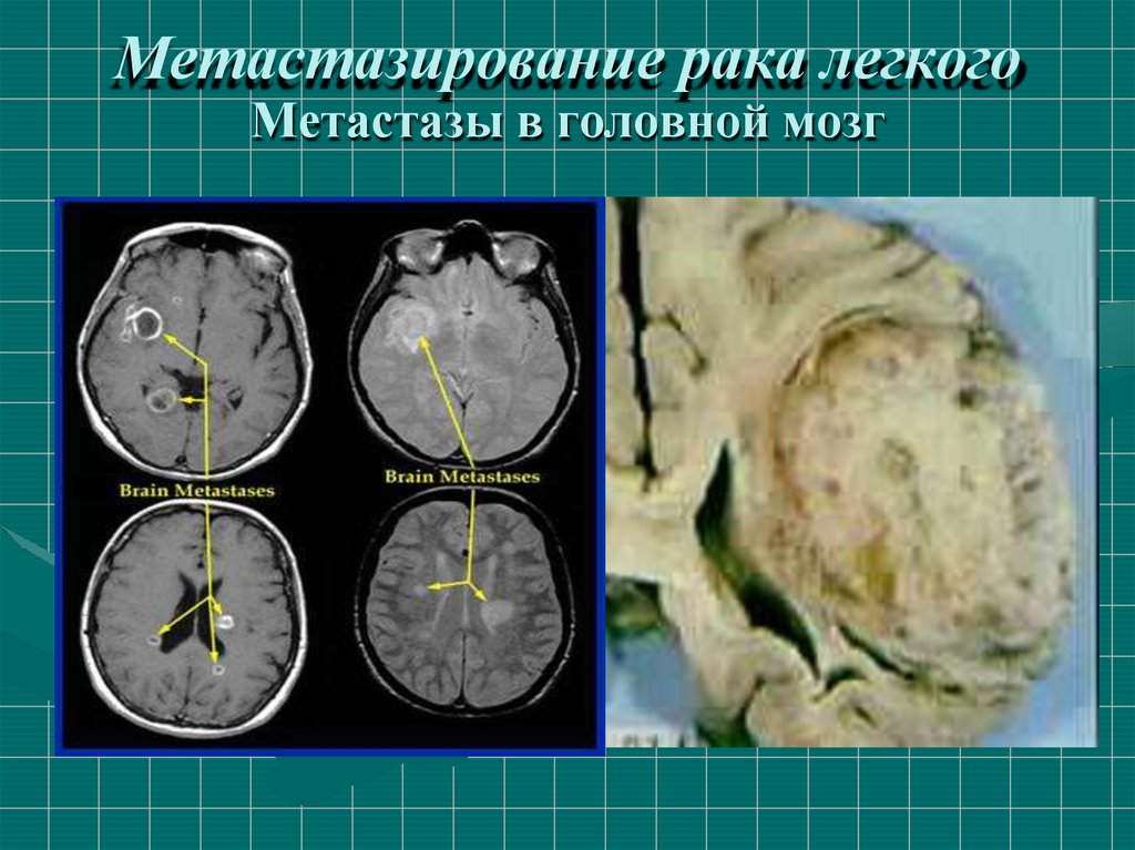 Метастазирование злокачественных. Метастатические опухоли головного мозга. Метастазы в головном мозге. Опухоль головного мозга метастазы. Отек головного мозга при метастазах.