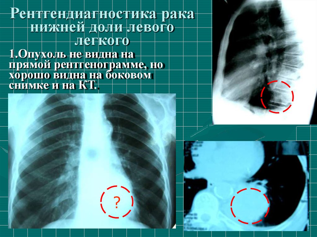 Центральный рак правого. Периферическая опухоль верхней доли правого легкого кт. Опухоль левого легкого. Опухоль нижней доли легкого. Опухоль левого легкого верхней доли.