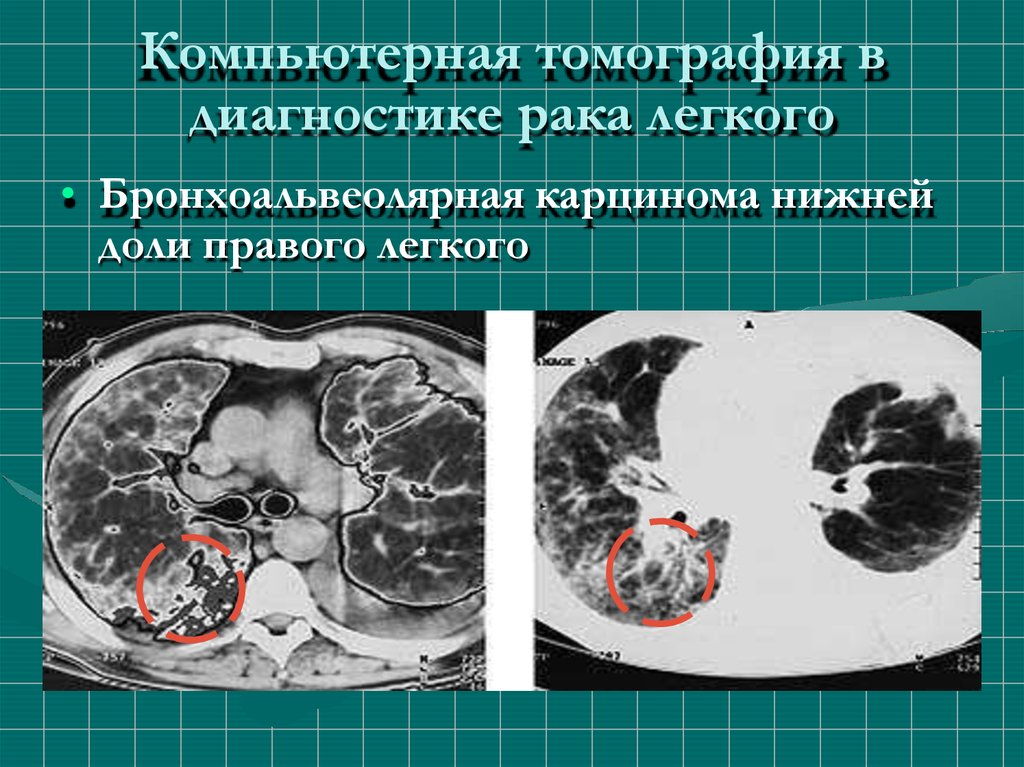 Бронхоальвеолярный рак презентация