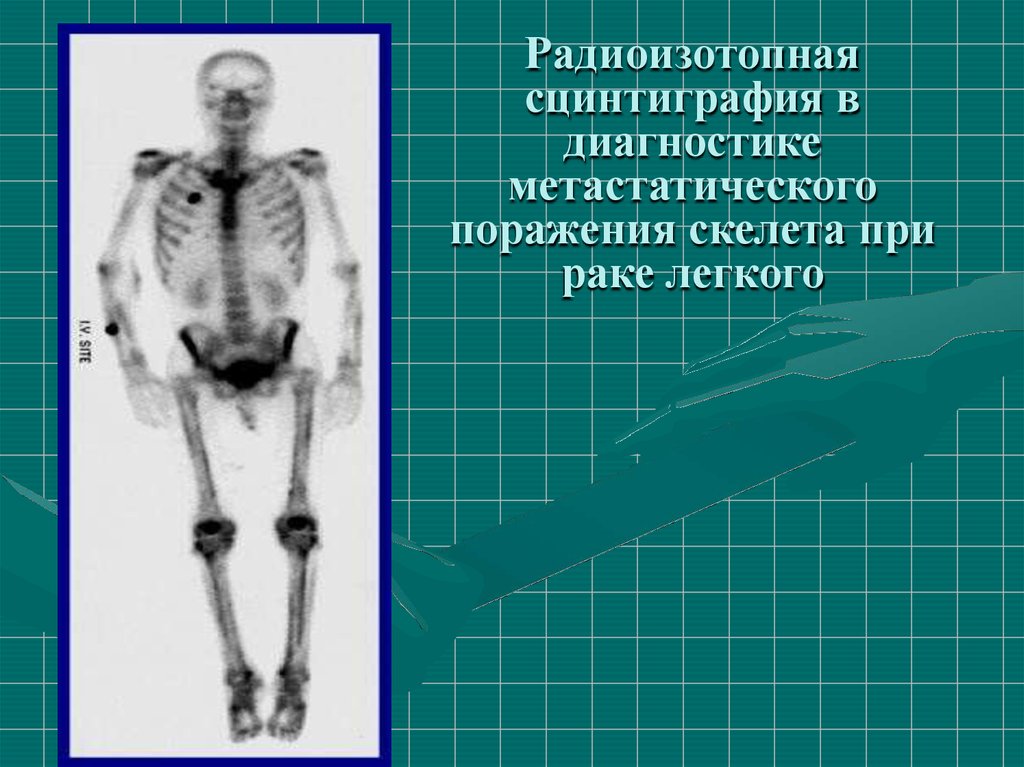 Сцинтиграфическая картина метастатического поражения костей скелета