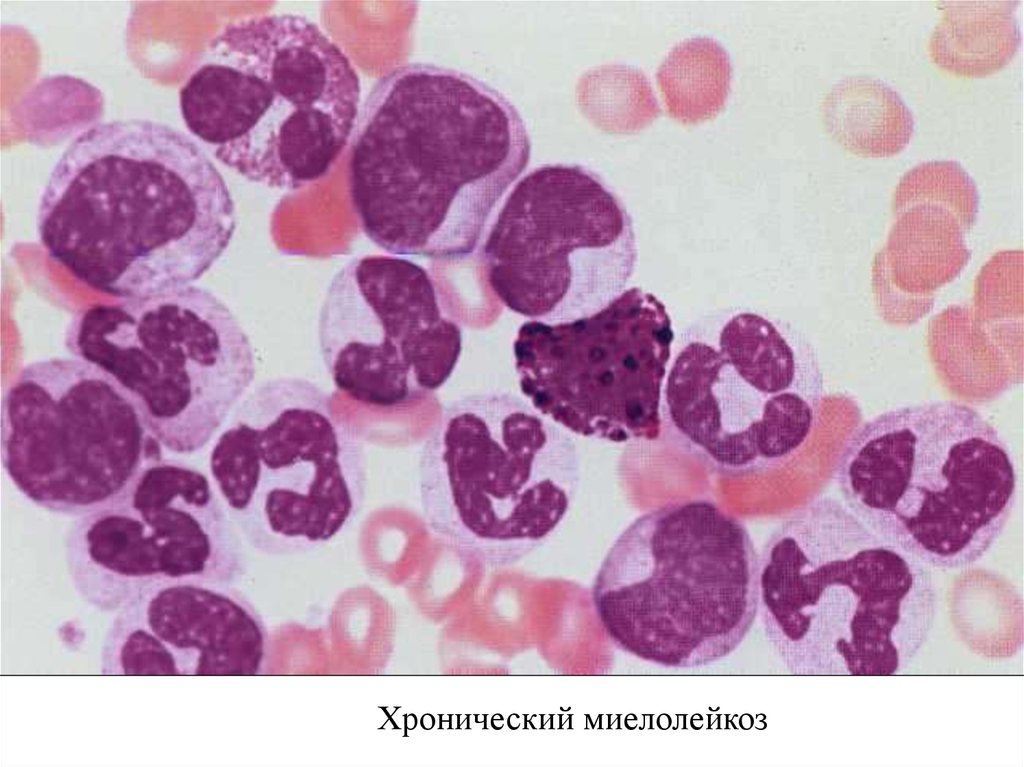 Миелоидный лейкоз. Острый миелобластный лейкоз мазок. Микроскопия хронический миелобластный лейкоз. Хронический миелобластный лейкоз мазок крови. Миелоидный лейкоз картина крови.