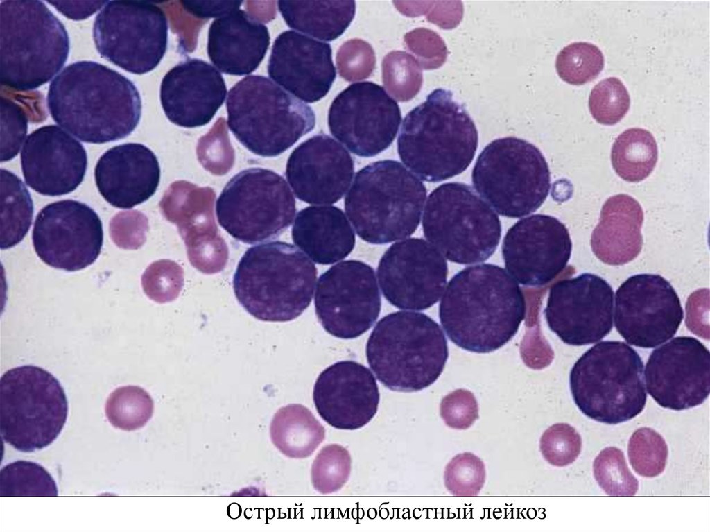Развитие лейкоза. Острый лейкоз бласты. Острый лимфоцитарный лейкоз. Лимфобластный лейкоз бластные клетки. Острый лимфобластный лейкоз картина крови.