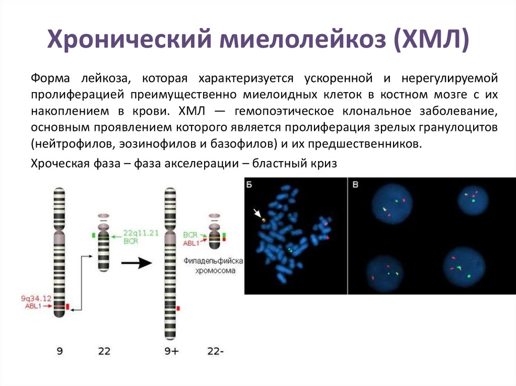 Миелолейкоз. Хронический миелоцитарный лейкоз. Хронический миелолейкоз цитогенетика. ХМЛ хроническая фаза. PH-негативный хронический миелолейкоз.