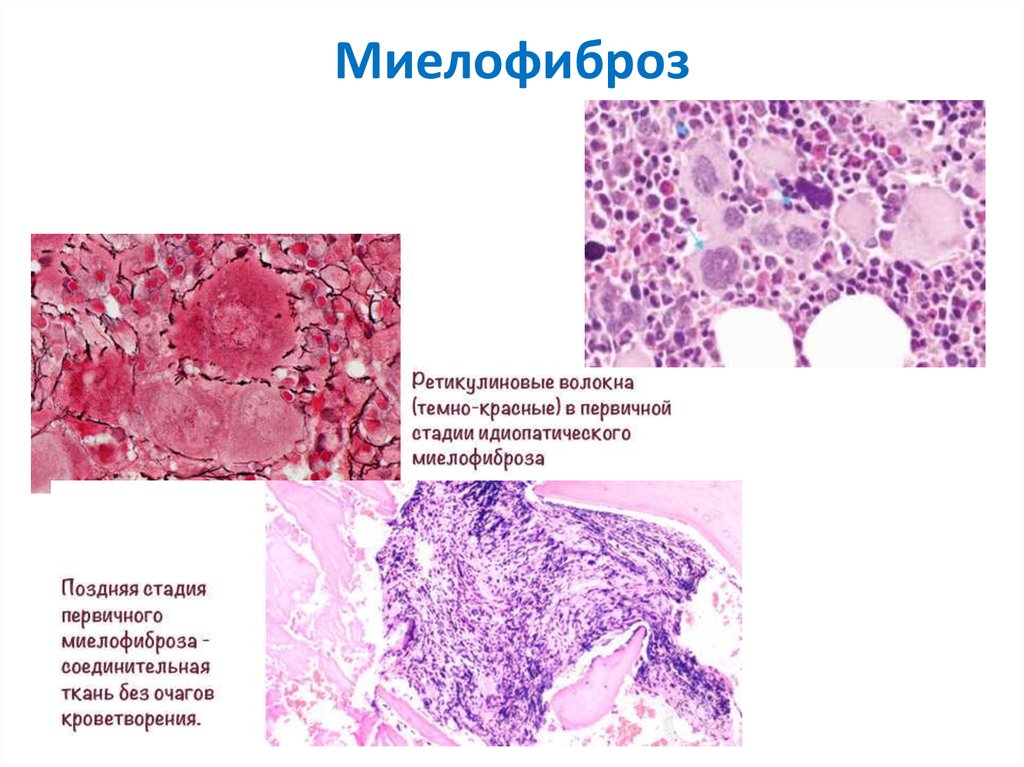 Фиброз костного мозга. Первичный миелофиброз гистология. Фиброзный костный мозг. Идиопатический миелофиброз картина крови. Миелофиброз гистология.