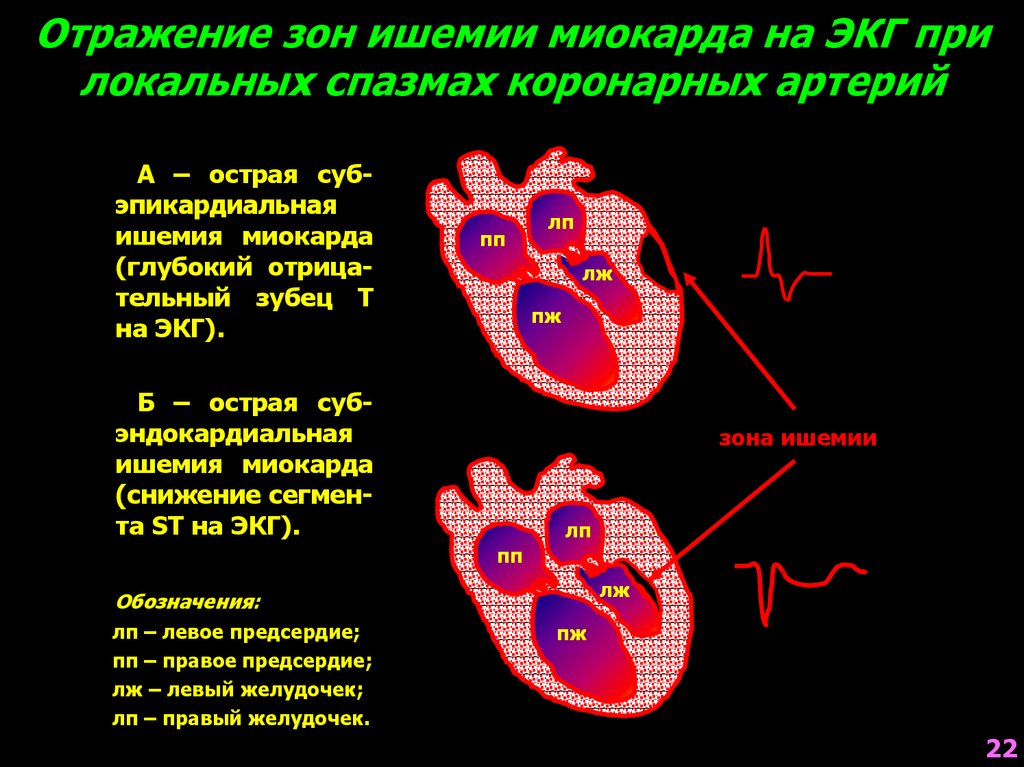 Стабильная ишемическая болезнь сердца презентация