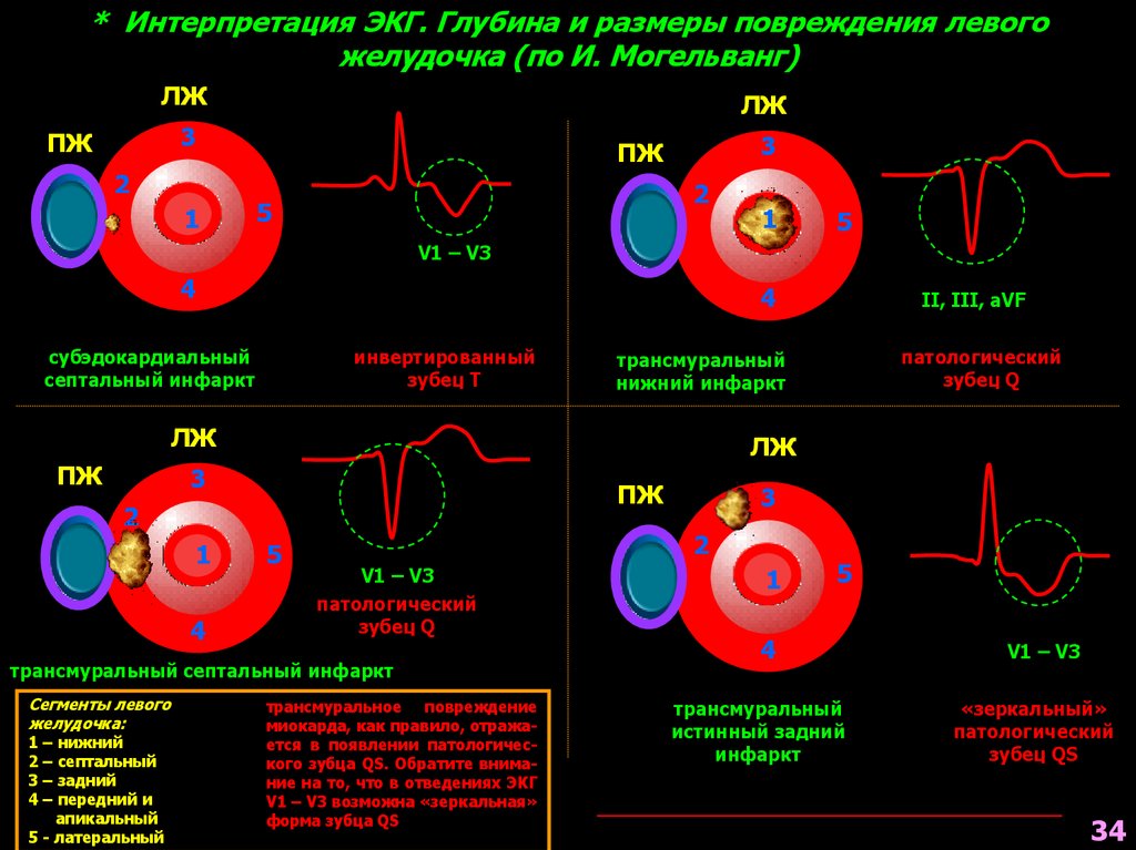 Задний трансмуральный инфаркт миокарда экг. Трансмуральный задний инфаркт левого желудочка. Нижнебоковой инфаркт миокарда на экг. Трансмуральный инфаркт миокарда прогнозы. Инфаркт миокарда нижне боковой стенки экг.