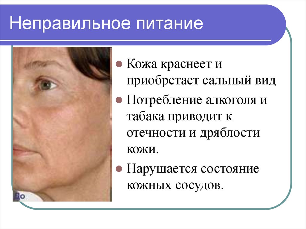 Вид кожи при избыточном питании. Последствия неправильного питания. Заболевания из за неправильного питания. Питание кожи. Влияние питания на кожу.