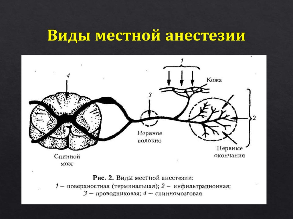 Местная анестезия схема