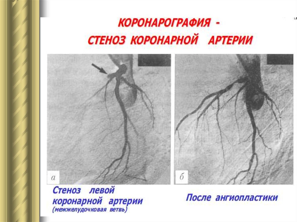 Коронарография это. Коронарография стеноз. Бедренная артерия коронарография. Коронарная ангиография (коронарография). Коронарография через бедренную артерию.