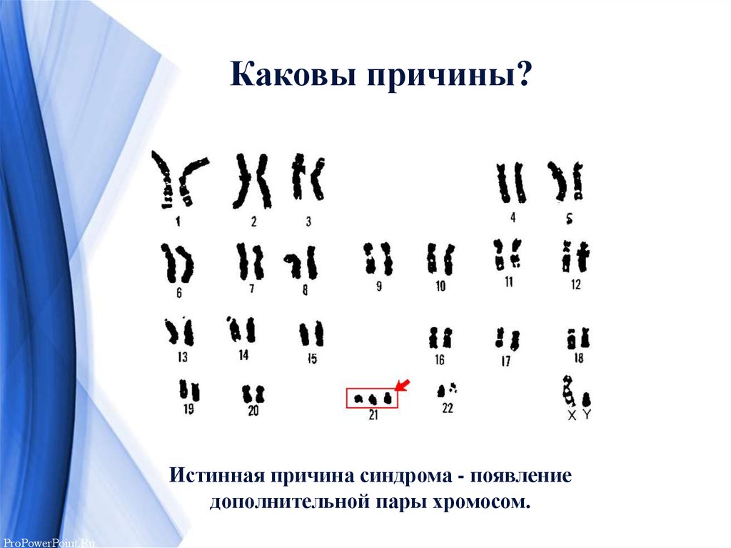 Появление дополнительной хромосомы. Кариотип синдрома кошачьего крика Тип наследования. Цитогенетический метод. Цитогенетическая карта человека с синдромом Дауна. Исследование синдрома Дауна цитогенетический.