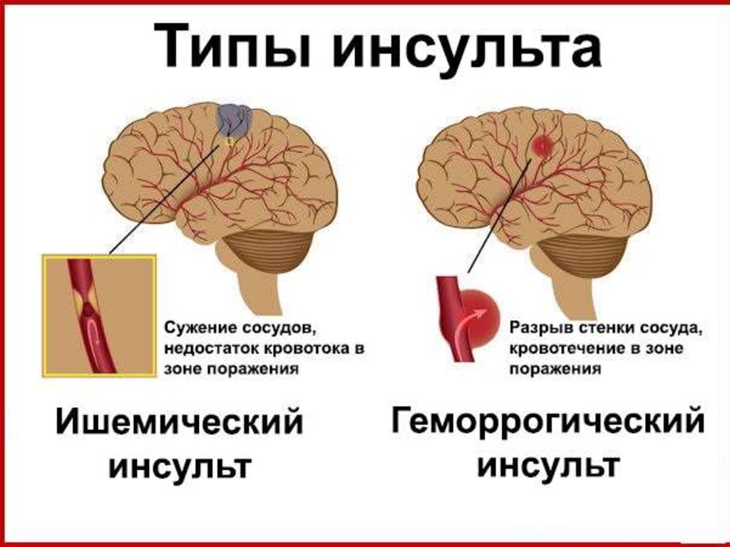 Ишемический инсульт картинки