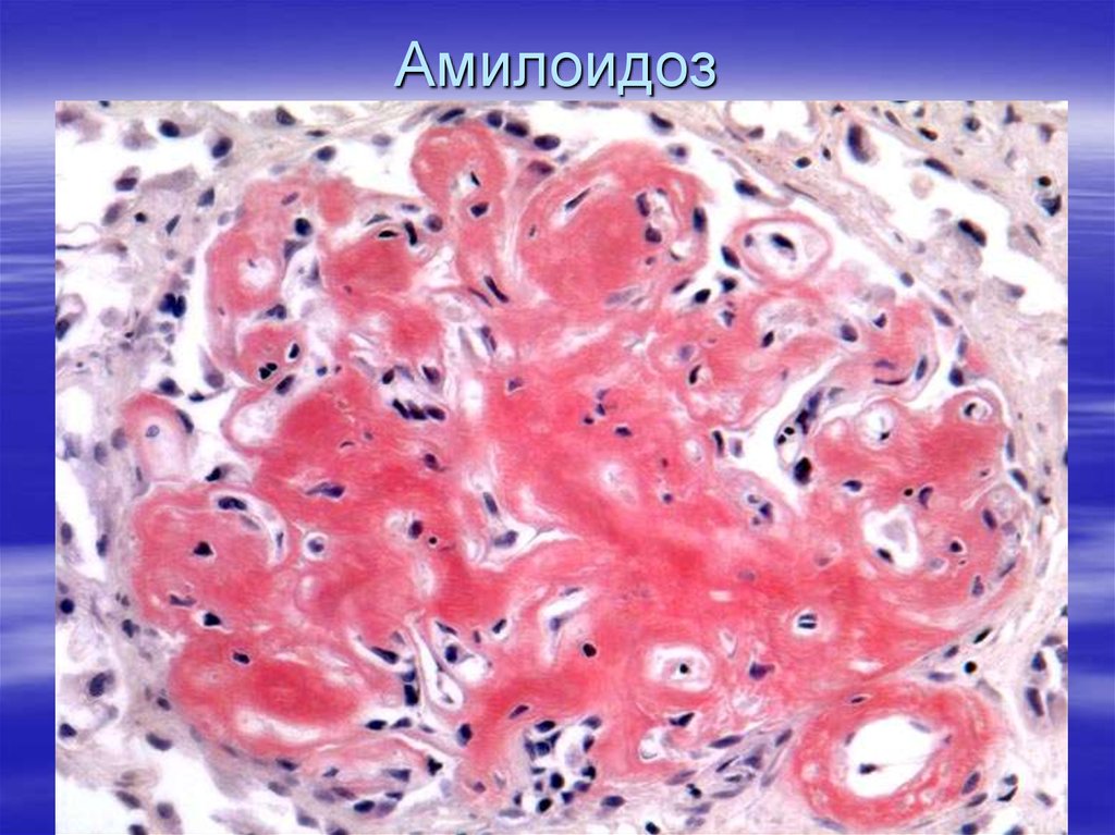 Амилоидоз почки рисунок