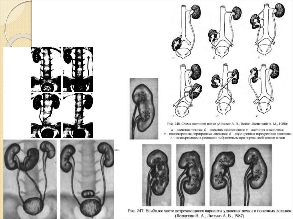 Аномалии развития почек. Спланхнология анатомия Гайворонский. Карточки по анатомии Спланхнология.