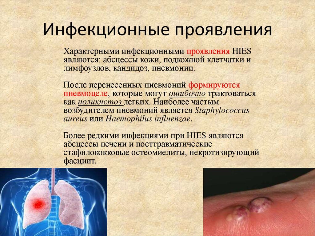 Инфекционные проявления