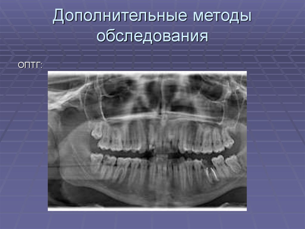 Остеомиелит нижней челюсти фото