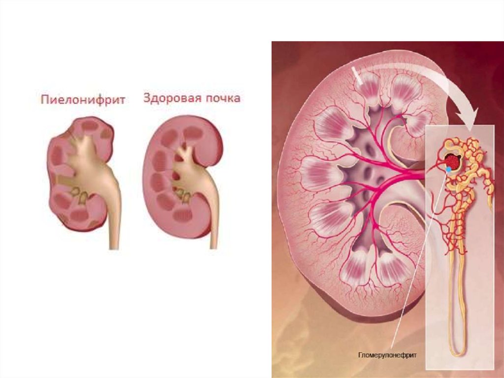 Гломерулонефрит у детей. Острый левосторонний пиелонефрит. Болезнь почек пиелонефрит у детей.