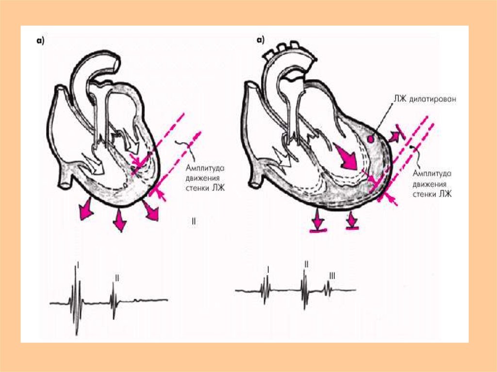 Движения стенок. Патологический 3 тон сердца. Появление третьего тона сердца. Механизм возникновения третьего тона.