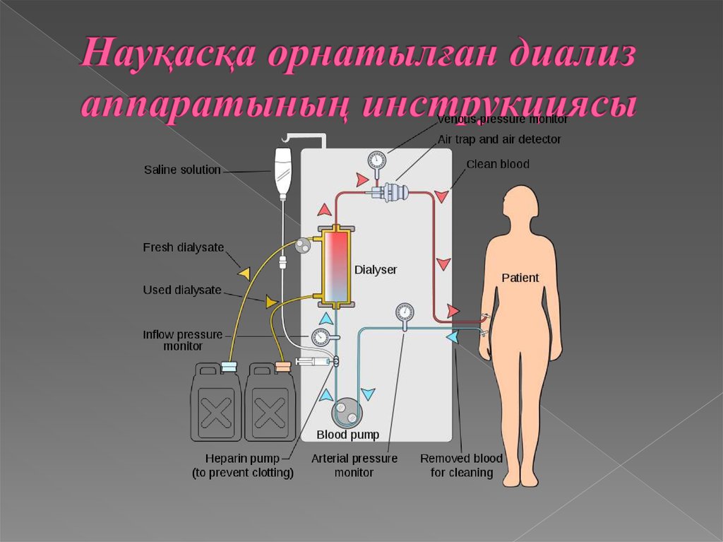 Науқасқа орнатылған диализ аппаратының инструкциясы