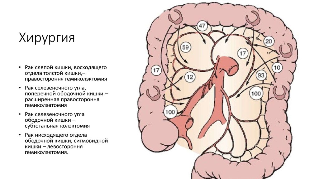 Рак ободочной кишки. Объёмное образование печёночного угла ободочной кишки. Тумор печеночного угла толстой кишки. Селезеночный изгиб кишечника. Опухоль селезеночного изгиба.