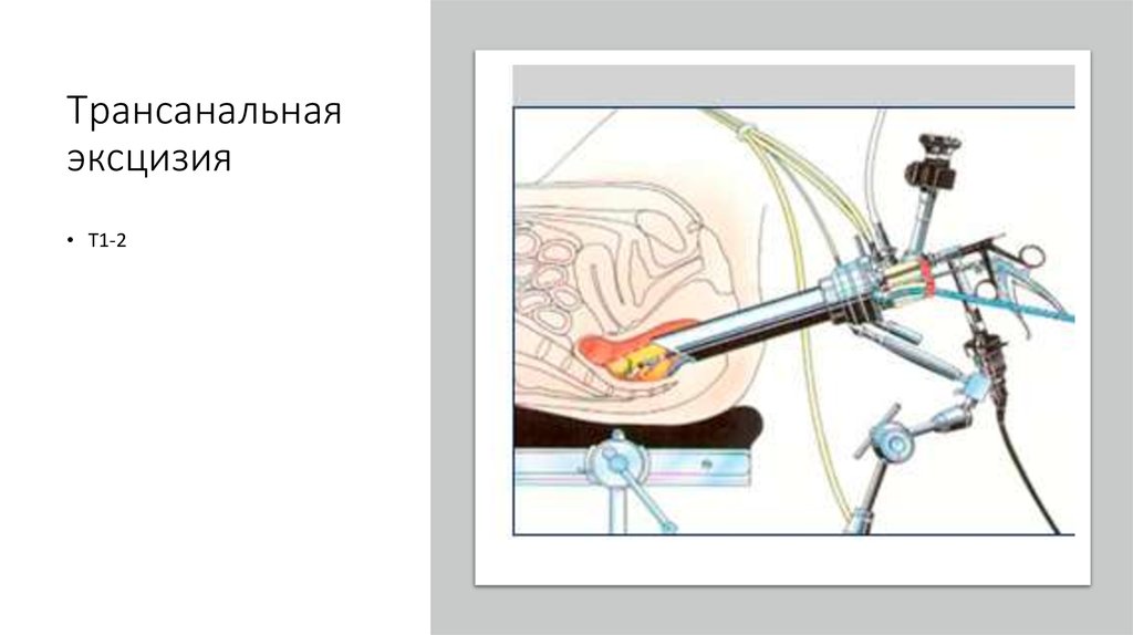 Эксцизия шейки матки. Трансанальная эндоскопическая операция. Трансанальная биопсия. Трансанальная миниинвазивная операция схема.