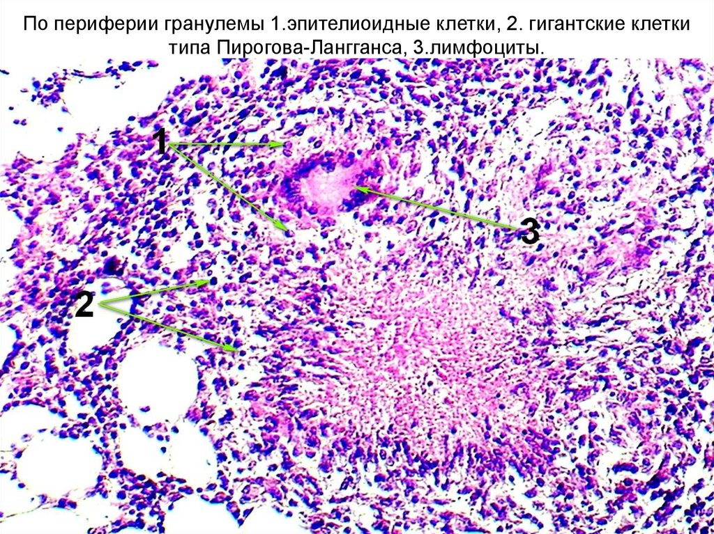 Клиническая картина периферической гигантоклеточной гранулемы характеризуется