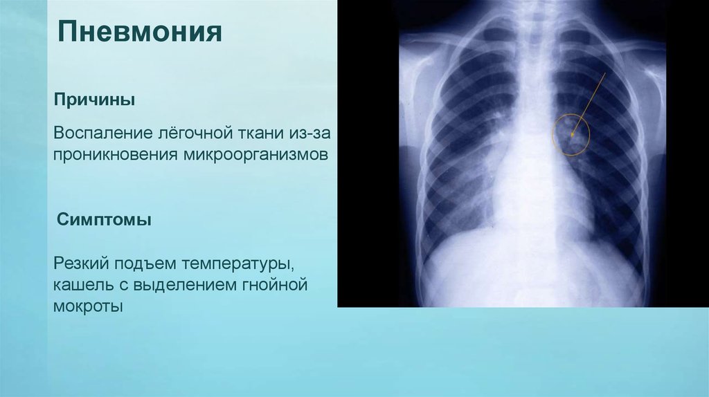 Презентация воспаление легких