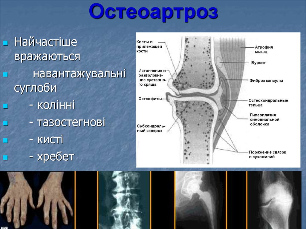 Рентгенологическая картина остеоартроза характеризуется тест