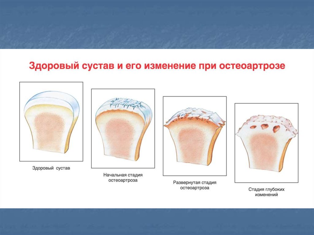 Остеоартроз презентация травматология