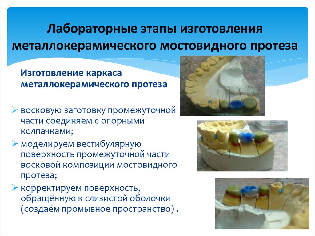 Виды мостовидных протезов. Клинико-лабораторные этапы мостовидных протезов. Лабораторные этапы изготовления мостовидного протеза. Клинические этапы мостовидного протеза. Клинические этапы изготовления мостовидного протеза.