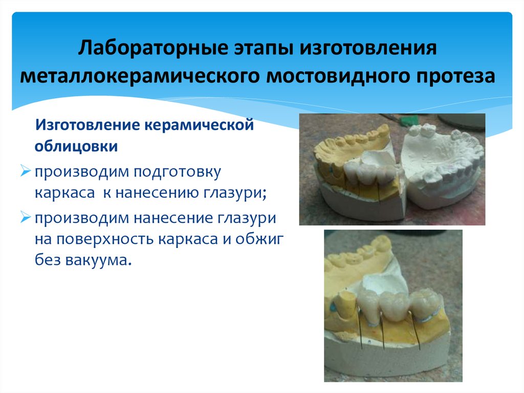 Клинико лабораторные этапы пластиночных протезов