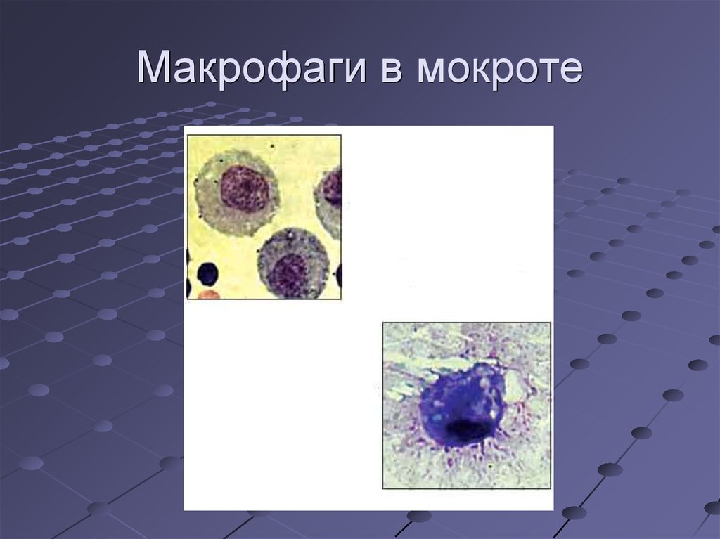Макрофаги 1 2. Макрофаги гистология. Альвеолярные макрофаги в мокроте микроскопия. Альвеолярные макрофаги в мокроте нативный препарат. Макрофаги с миелином в мокроте.