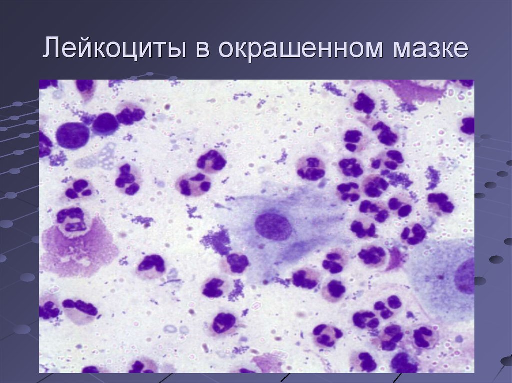 Микроскопическое исследование на эозинофилы окрашенного мазка мокроты